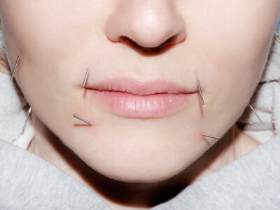 Afraid of Acupuncture? Don’t Be