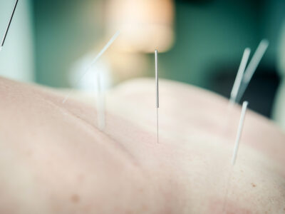 Acupuncture VS. Acupressure: What’s The Difference?