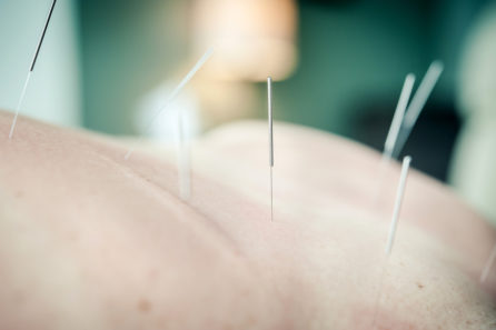 acupuncture