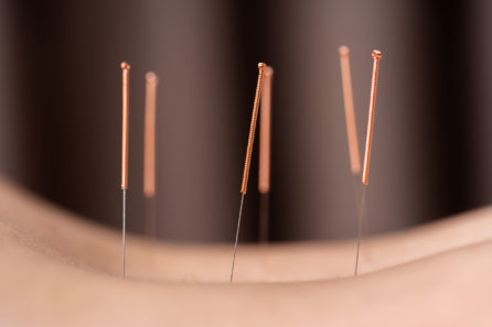 Acupuncture Needles