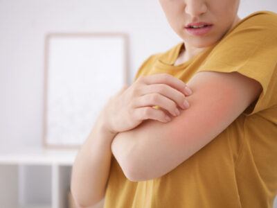 How To Treat Your Eczema With Eastern Medicine