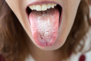 Tongue In Eastern Medicine