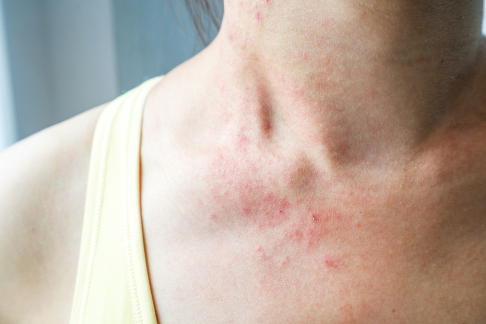 How to fix skin rash with eastern medicine