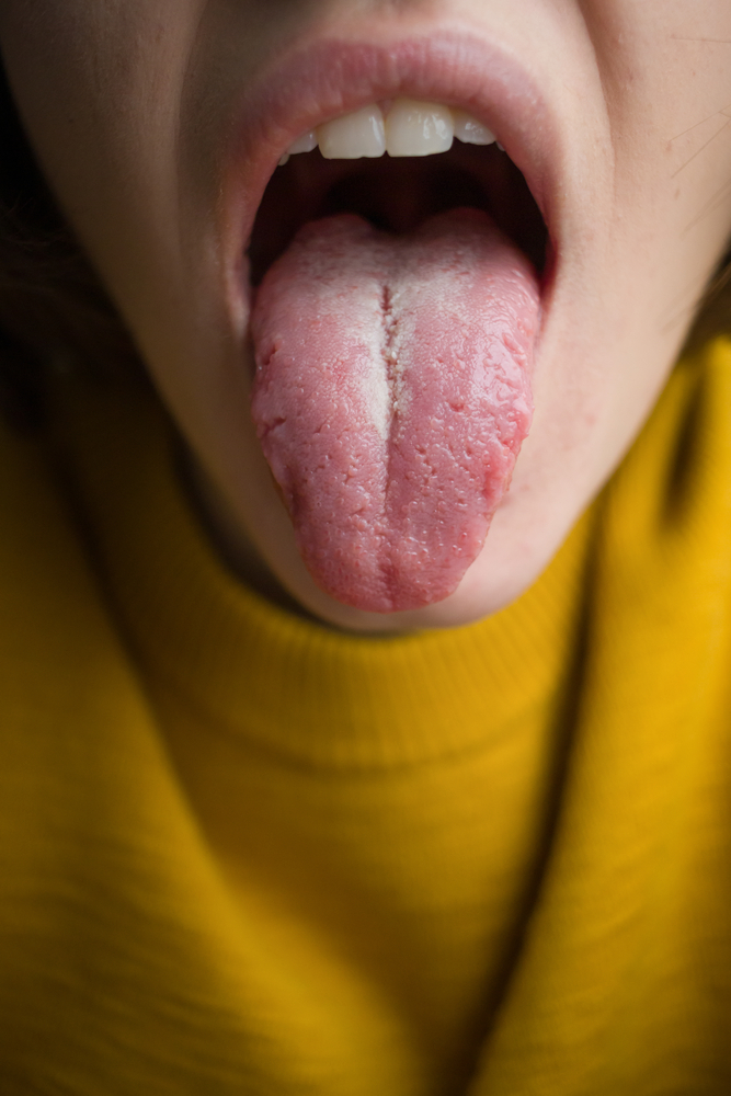 Color Of Tongue In Eastern Medicine
